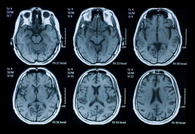 istock-brain-scan